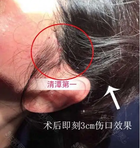 小切口面部提升和拉皮的区别在哪里