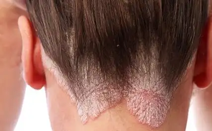 5种实际有效的头皮银屑病治疗方法