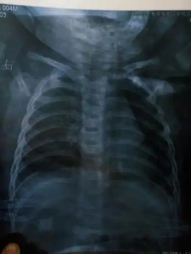 宝宝五个月咳嗽有痰鼻子不通气,今天去拍的胸片,希望医生看看