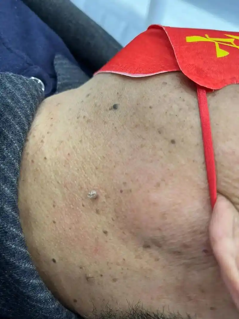 刺瘊提取对比图 - 抖音