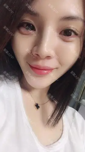 第二天,玻尿酸卧蚕作为消费者很多人认为,会打不好形_圈子-新氧美容