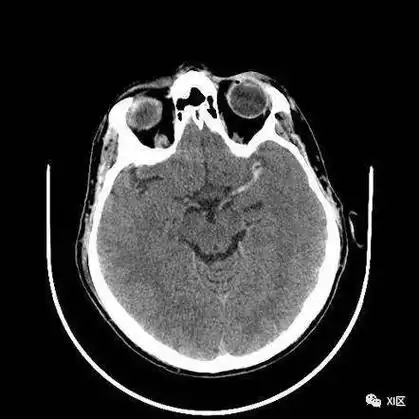 急性缺血性脑卒中多模式头颅ct图像解读