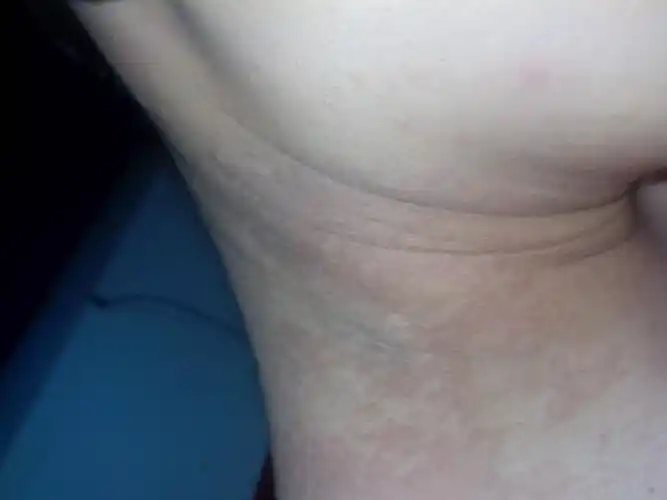 身上跟癣类似的小斑点还会蔓延全身是什么病? 跪求高手指点.