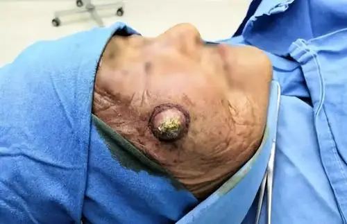 回想半年前,吴老太太不知道什么原因下脸上长了瘤子.