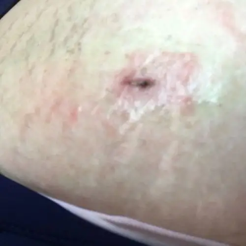 宫外孕微创手术二十天后刀口上起了好多红疙瘩,好痒!