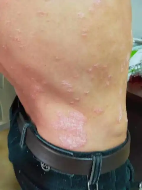 银屑病各个阶段的表现图片