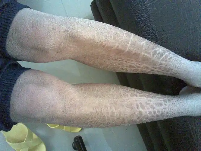 鱼鳞病存在传染倾向吗