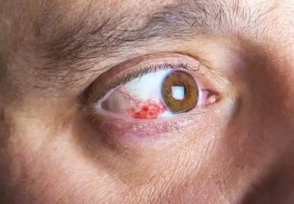 尿毒症多是"拖"出来的,医生劝你:脸部有这4个症状,去查查肾