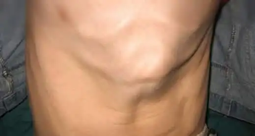 鸡胸图片什么样子:鸡胸的危害和造成的鸡胸原因-昕薇网