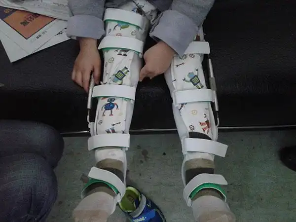 常见问答|湖南佳满假肢 您的假肢装配专家!