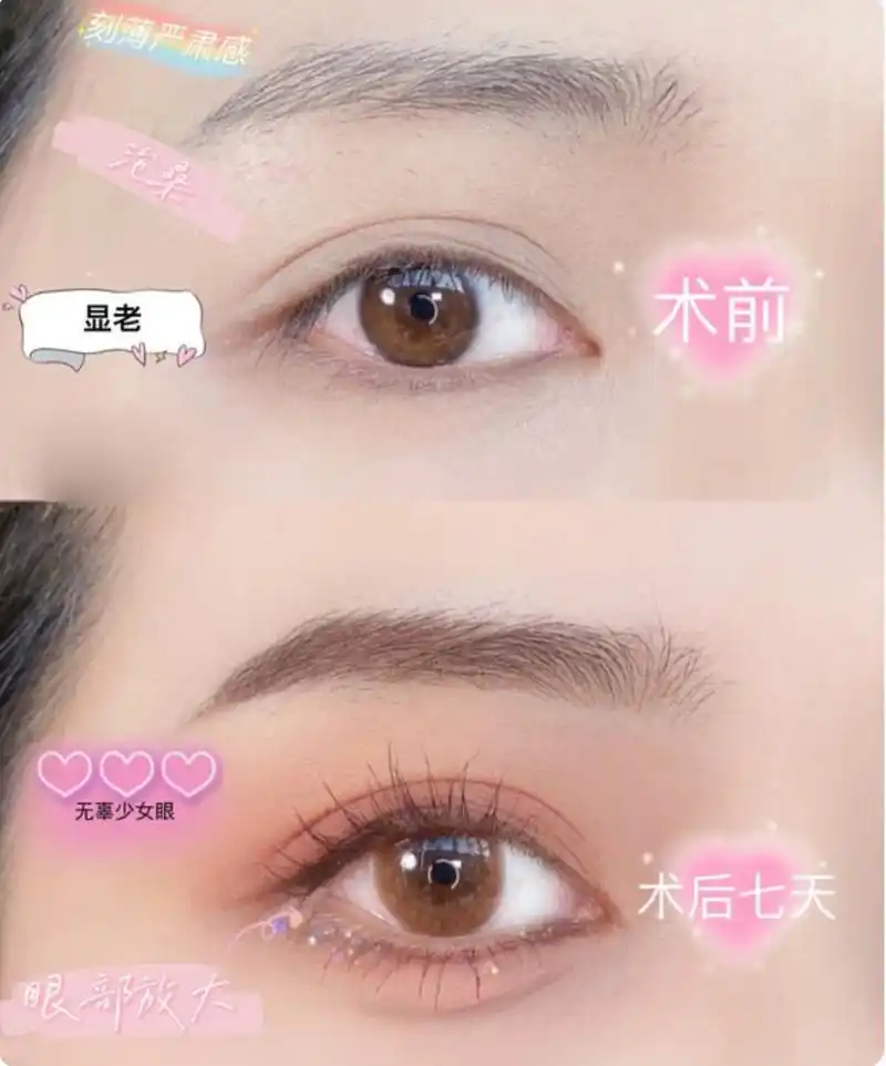 玻尿酸填充卧蚕