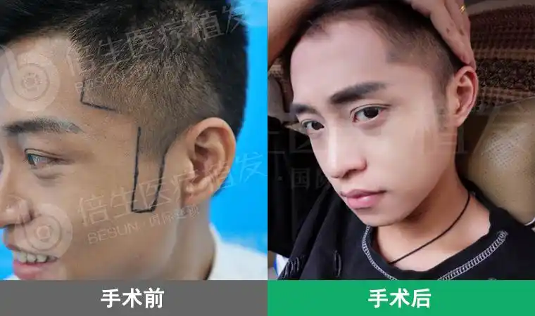 刘先生鬓角种植800单位效果展示