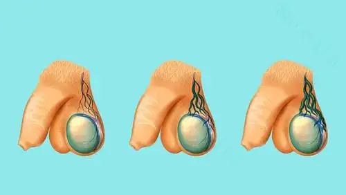 有精索静脉曲张侧的阴囊,较正常侧的阴囊位置较低,睾丸表现为下垂状态