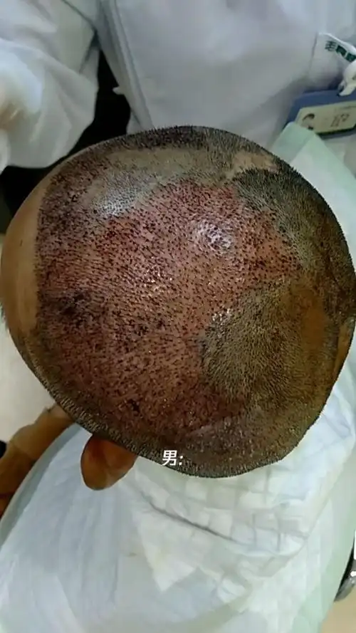 头顶大面积疤痕种植,以后都有头发,心里美美哒