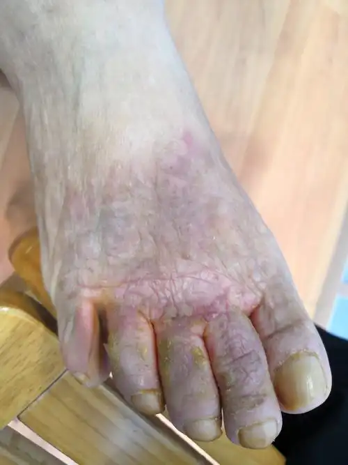 双脚脚汗多伴瘙痒肥厚湿疹中医中药调理案例 - 好大夫在线