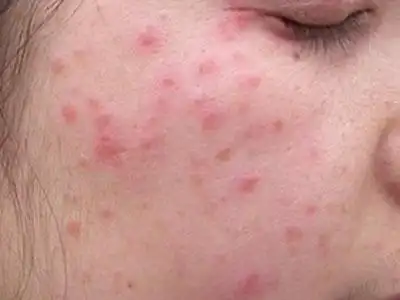 医疗资源概述病因症状检查诊断治疗并发症预防疾病知识螨皮炎热门搜索