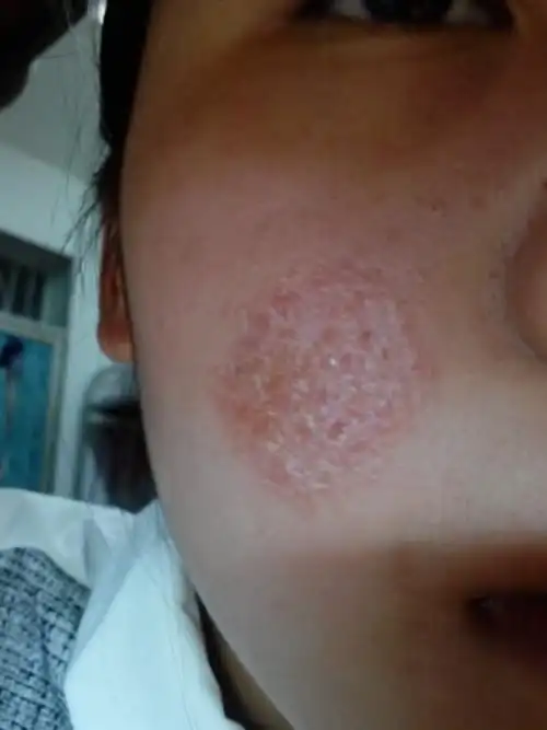 并且还会流黄水.然后,第二天又会有脱皮.