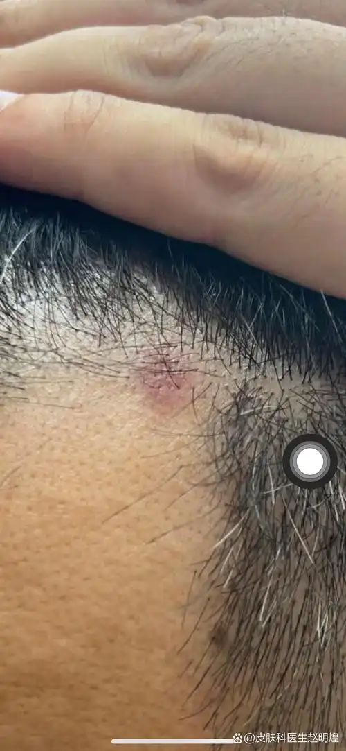 头皮的红斑,小心牛皮癣,可以做个皮肤镜看下.