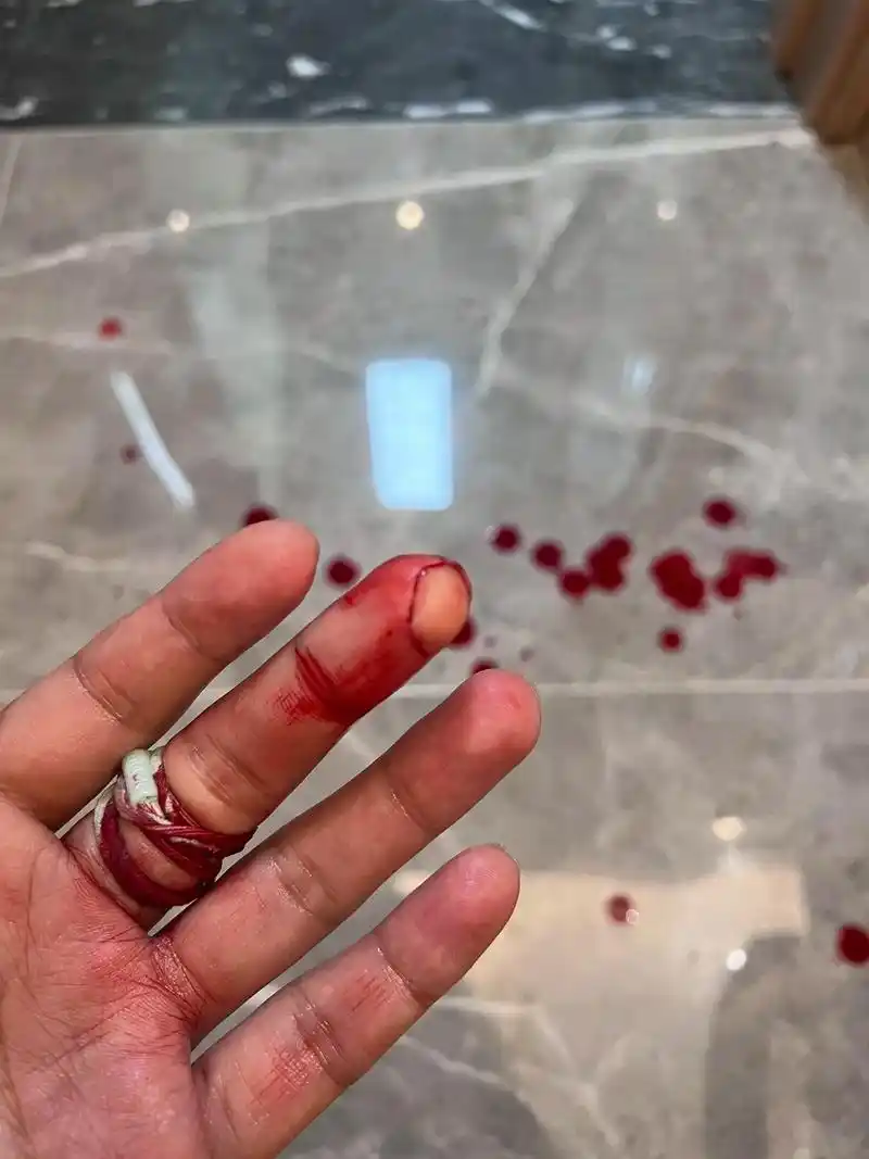 切菜切到手了.做饭切冰冻的肉块,把手指肚切掉一块,呼呼流血, - 抖音