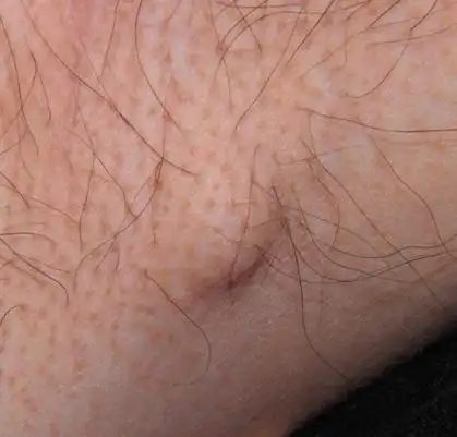 腋窝皮下长了个比黄豆大得疙瘩 按得时候有点疼 这是啥啊以前从来没有