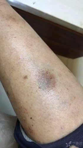 求助:腿部皮肤有黑斑 - 皮肤与性传播疾病讨论版 -丁香园论坛