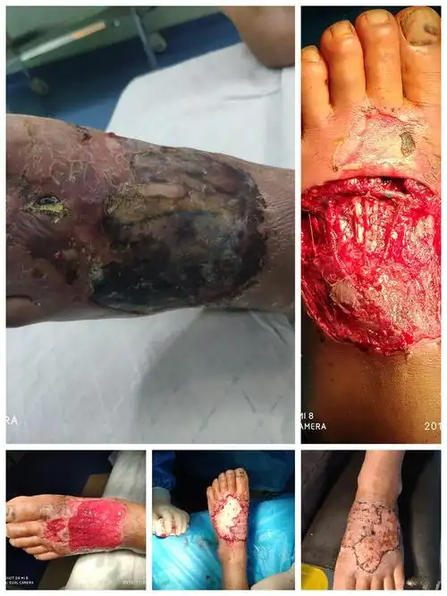 足背皮肤坏死植皮术