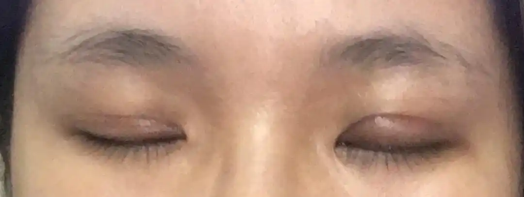 提肌,双眼皮,一个月,感觉失败了