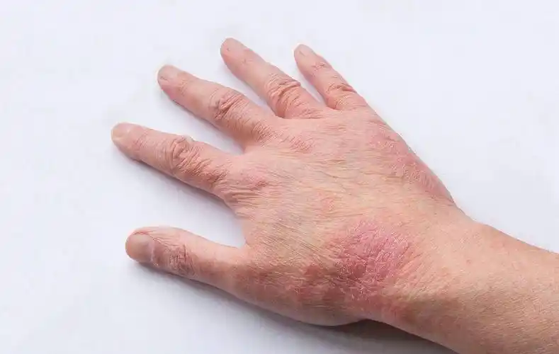 为什么老是长湿疹湿疹图片初期症状图片