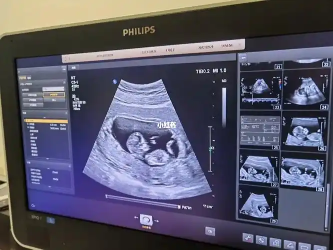 12周nt猜男孩女孩啦