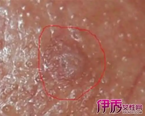 【图】女尖锐湿疣症状图片 告诉你2个病症的早期症状