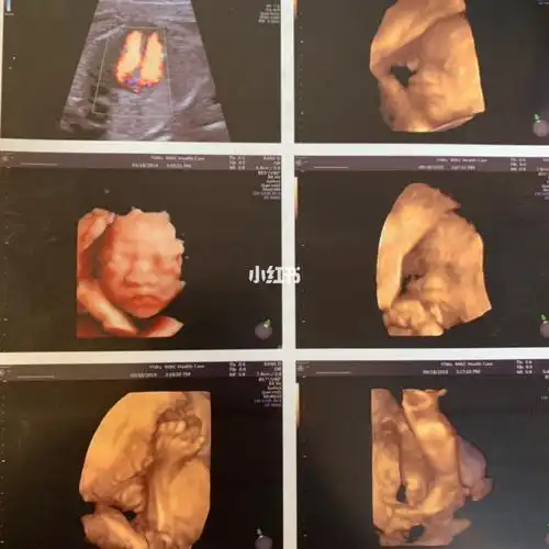 四维拍出来,当时一看好丑啊,这鼻子也太大了,我的显性基因也太强了