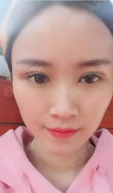 双眼皮术后20天了,已经可以正常出门了