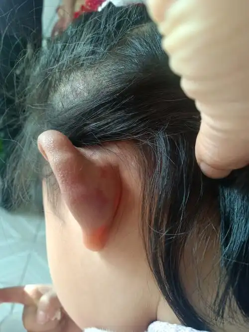 孩子8岁,右耳廓动脉血管畸形,表面紫红色,肥厚,跳动,有发热感,三四个