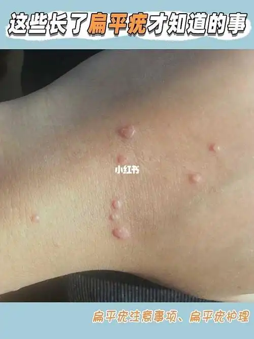 长了扁平疣这些不能忽视的事