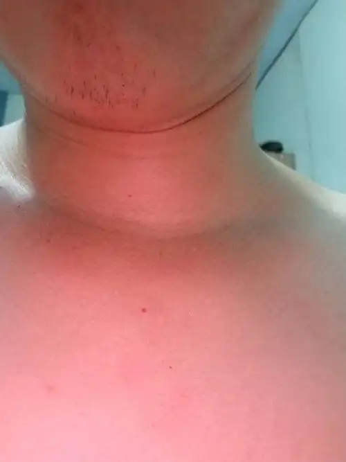 胸口这个是啥,红红小点,有凸起,不痛不痒.