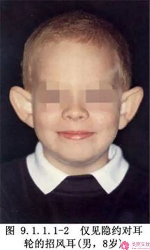 整形招风耳矫正手术有并发症吗招风耳矫正手术需要多长时间恢复