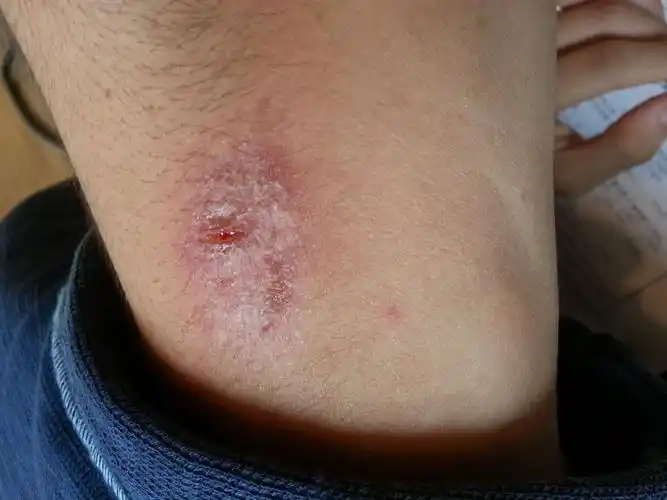 皮肤痒,一年了,求解