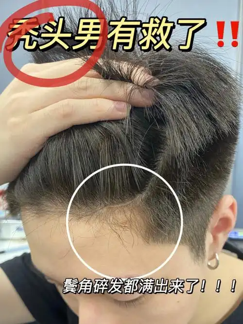 鬓角m头有救了发量都洗回来了