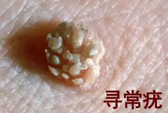 主要是各种疣,比如明显的生殖器疣以及不明显的宫颈,阴道,外阴,尿道