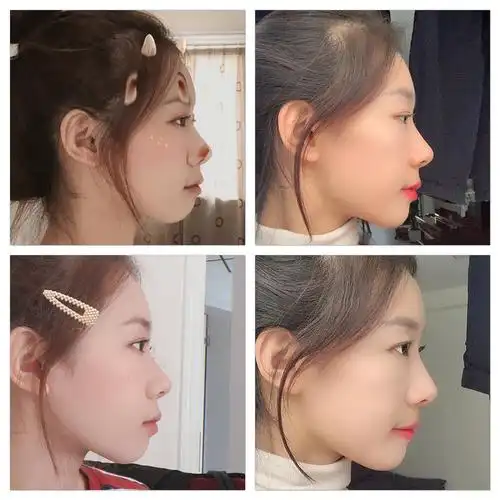 牙套真的很神奇侧脸变化