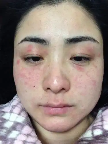 脸部过敏发红快速消除脸部过敏发红怎么办