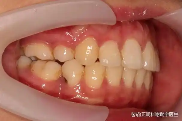 前牙太长包下牙了,不矫牙可以吗?