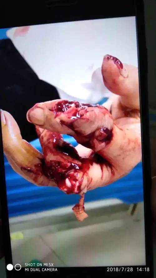 左手中间三根手指被榨汁机绞断,还截了一根手指,这个好了能评几级伤残