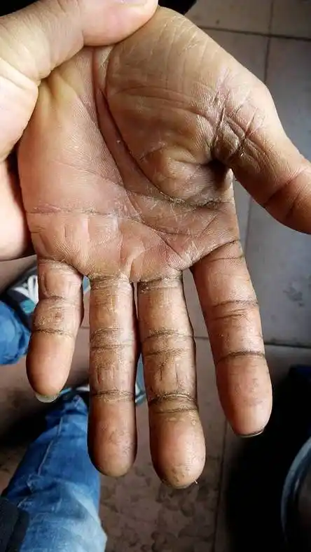 我爸的手因经常接触油污,干燥开裂脱皮,请问有什么比较简单容易有效的