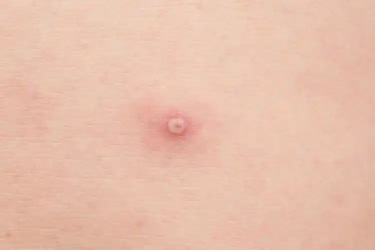 阴茎长毛囊炎的症状图片