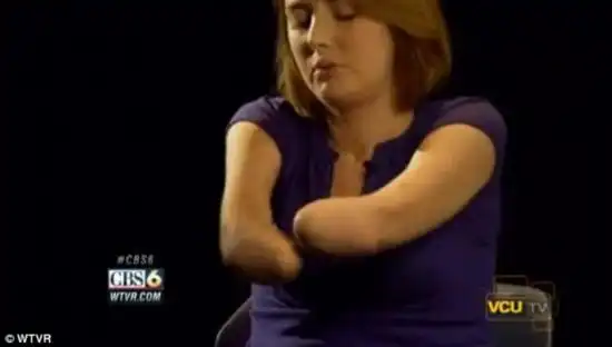 美一截肢女子完成双手移植手术 恢复部分正常生活【5】