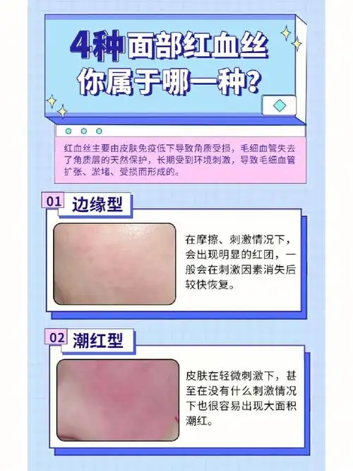 这4种红血丝哪一种是你的类型