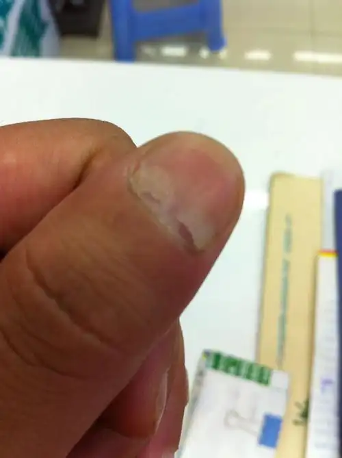 最近手指甲盖根部发白,已经空了,感觉想脱落一样,最早是脚指甲,后来