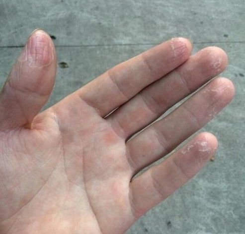 手指蜕皮愈裂霜开裂手足防裂口脚干裂起皮肤干燥粗糙脱皮膏修复霜