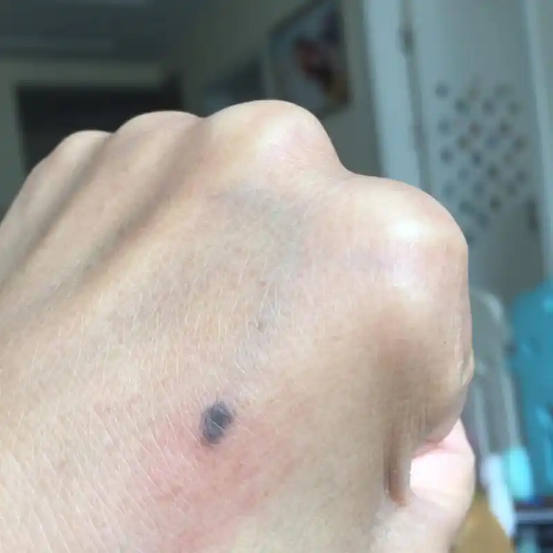 帮忙看看我手背的这个颗痣,我想去医院手术切了它,怕他变得不好了